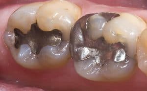 Dental Fillings