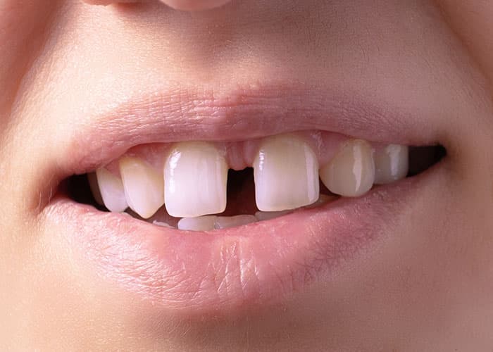 Teeth Gaps Treatment