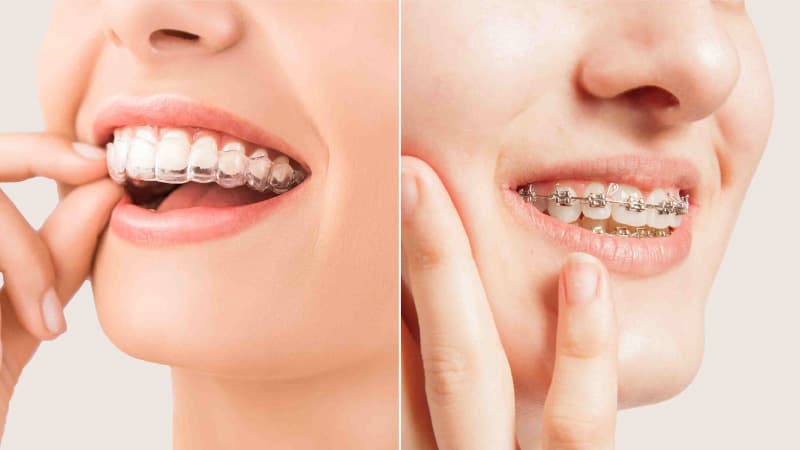 Braces vs. Aligners: What’s Best for You?