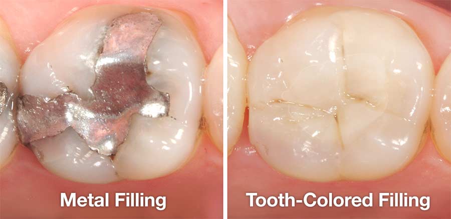 Dental Fillings