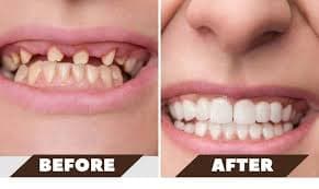 Teeth Gaps Treatment